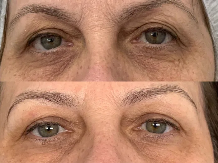 Before and after 3 sessions with LHALA Peel · Microneedling + LHALA Triple C