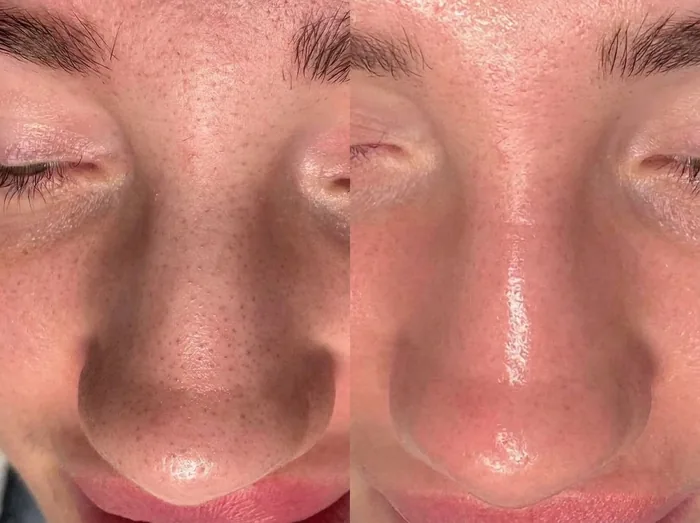 Before and after 2 sessions with LHALA Peel + LHALA Ole · LHALA Peel + LHALA Ole