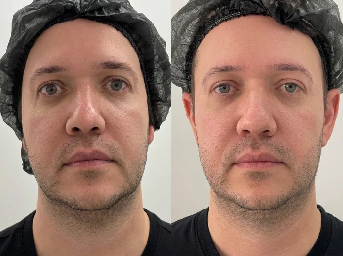 Before and after 3 sessions with LHALA Peel · LHALA Peel + LHALA Ole