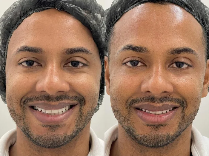 Before and after 2 sessions with LHALA Peel · LHALA Peel
