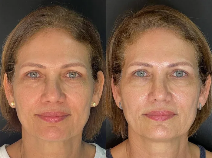 Before and after 2 sessions with LHALA Peel · LHALA Peel