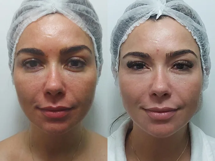 Before and after 2 sessions with LHALA Peel · LHALA Peel