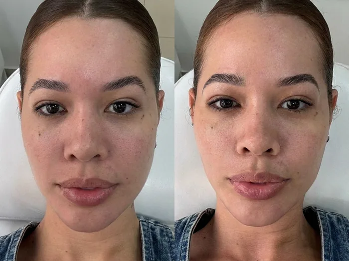 Before and after 2 sessions with LHALA Peel · LHALA Peel