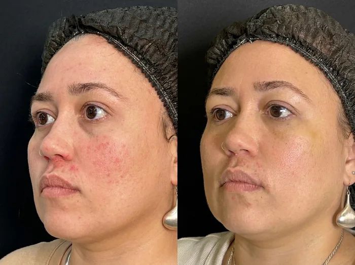 Before and after 2 sessions with LHALA Doctor + LHALA Ole · LHALA Peel + LHALA Ole