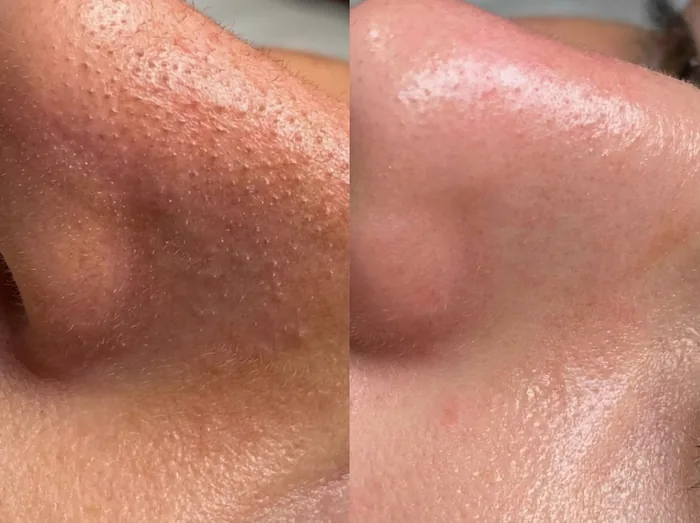Before and after 3 sessions with LHALA Peel · LHALA Peel