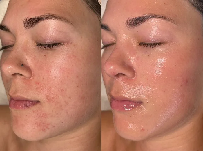 Before and after 2 sessions with LHALA Peel + LHALA Ole · LHALA Peel + LHALA Ole